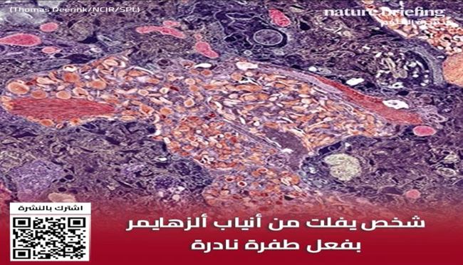 شحص يفلت من أنياب الزهايمر بفعل طفرة نادرة