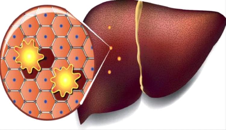 بهذه الطريقة ستقود الكبد الى الإصابة بالسرطان !