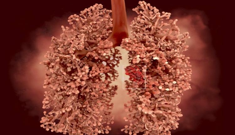 دراسة تكشف صلة خطيرة بين النظام الغذائي الحديث وسرطان الرئة