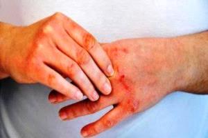 دراسة: حمل الرضع في أقمشة معالجة بمبيدات يقلل حالات الملاريا