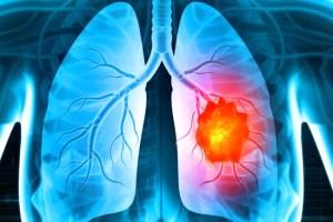 روسيا تسجل علاجًا لأكثر سرطانات الرئة خطورة