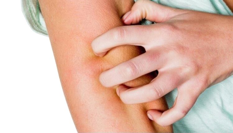 احذر الحكة بعد الاستحمام.. قد تكون أكثر من مجرد جفاف في الجلد!