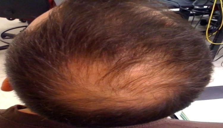 أطباء يحذرون: علاج موضعي للصلع يسبب مشاكل صحية خطيرة
 
