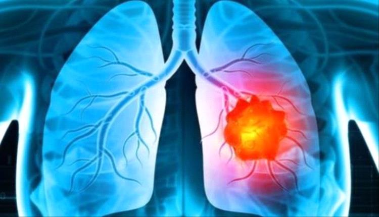 اكتشاف لقاح جديد للوقاية من سرطان الرئة