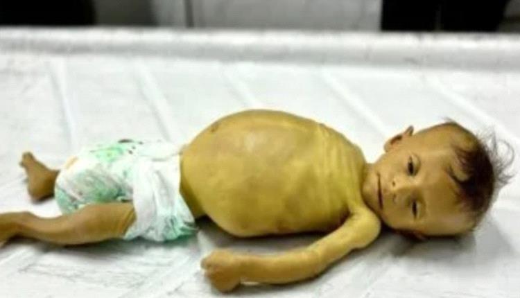 وفاة طفل فلسطينى بسبب المجاعة وتضخم فى الكبد