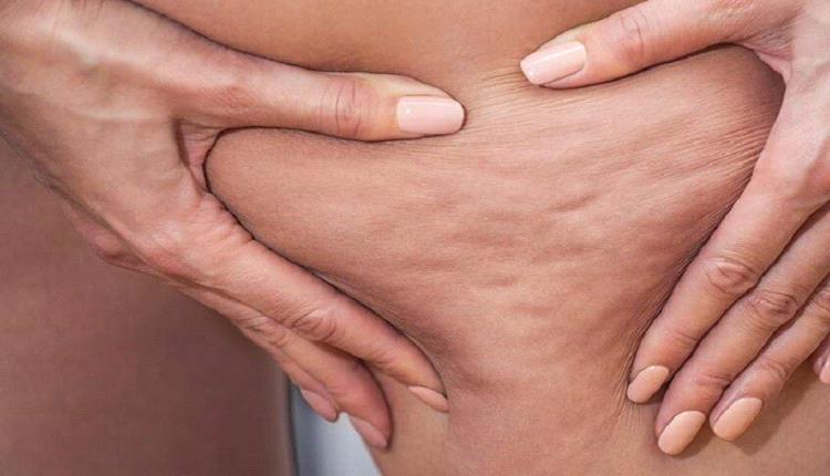 أطعمة تحفز التهاب الأنسجة تحت الجلد.. وبدائلها المفيدة