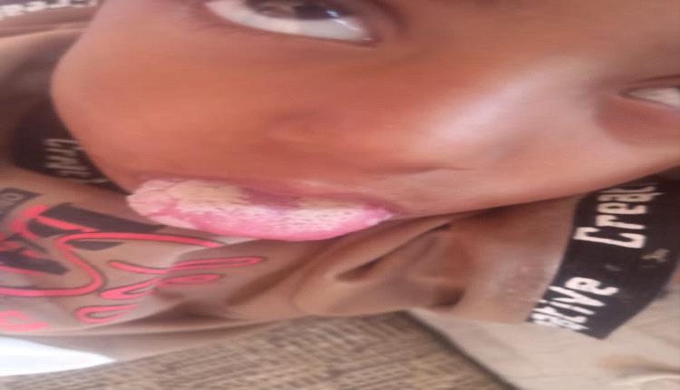 مناشدات عاجلة في الضالع جراء تفشي وباء "فطريات اللسان" بين أطفال منطقة تورصة