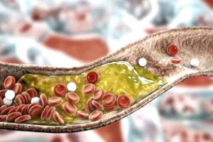 تعرف على أطعمة تخفض الكوليسترول خلال أسابيع