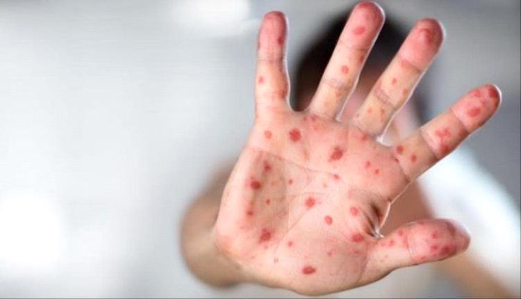 تفشي عدوى الحصبة في 14 منطقة بإسرائيل..