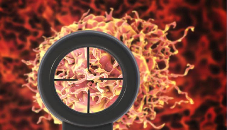 استراتيجية مبتكرة لعلاج سرطان البروستات في مراحله الأولى