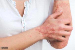 التهاب الدم: الأعراض، المراحل، والتحذيرات الطبية