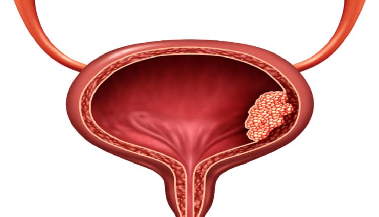 عمى الألوان وسرطان المثانة!.. علاقة غريبة يفسرها العلم