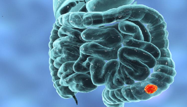 سبب رئيسي للإصابة بسرطان القولون