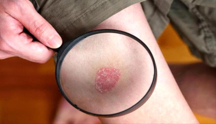 دراسة تكشف طريقة فعّالة لتقليل أعراض الصدفية