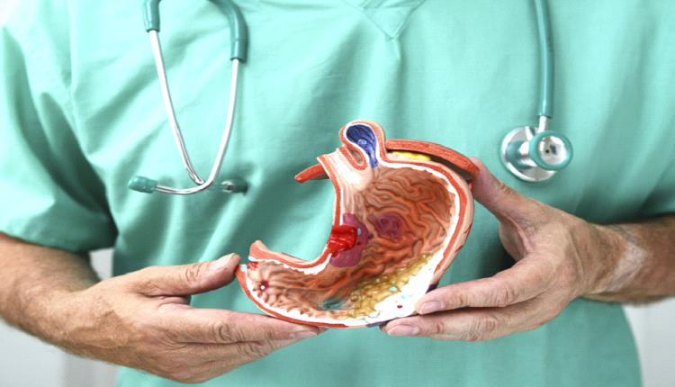 أخصائي أورام يوضح طبيعة سرطان المعدة