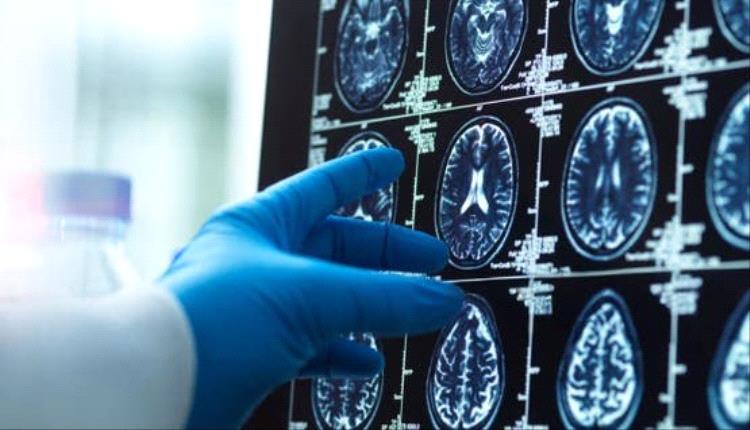 علماء يكتشفون أن الدماغ البشري يتكون في الواقع من عضوين منفصلين